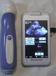 Mobisante smartphone ultrasound Mobisante smartphone ultrasound